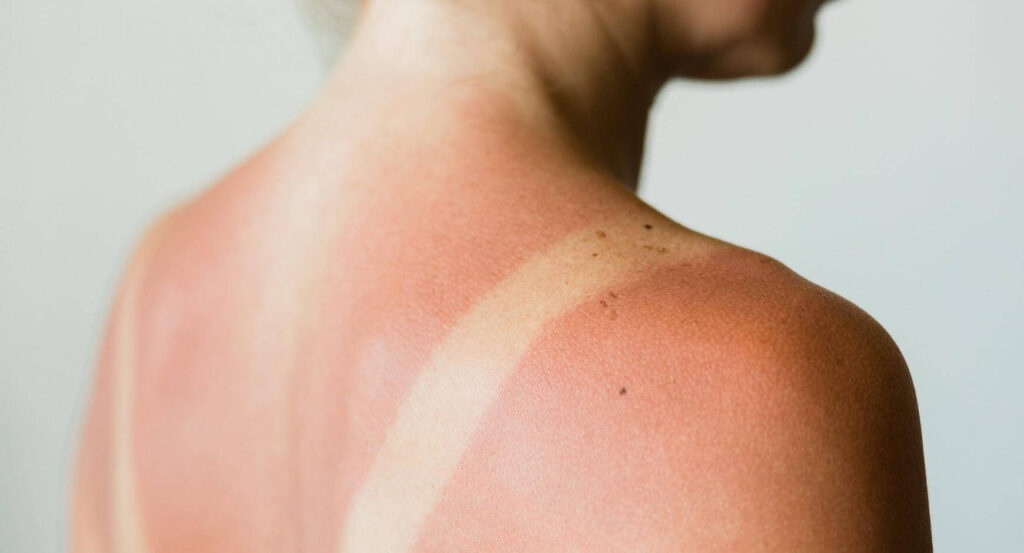 image of a person with sunburn